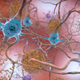 En el cerebro de una persona con la enfermedad de Alzheimer, las proteínas beta-amiloides se agrupan para formar placas (marrón), mientras que los grupos de proteínas tau forman enredos (azul). Se cree que estas estructuras alteran el funcionamiento normal del cerebro.